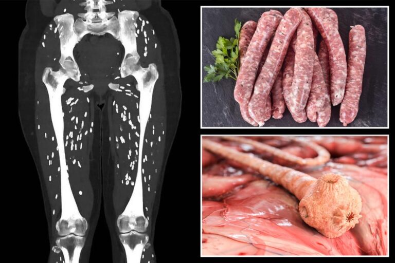 Disturbing CT scan reveals horrific parasite infection due to raw pork sausages

